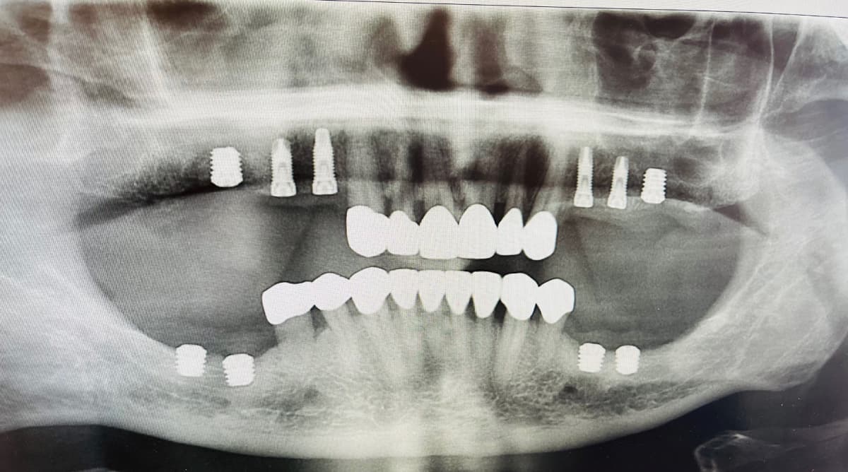 Image d’aperçu de chirurgie d'implants dentaires