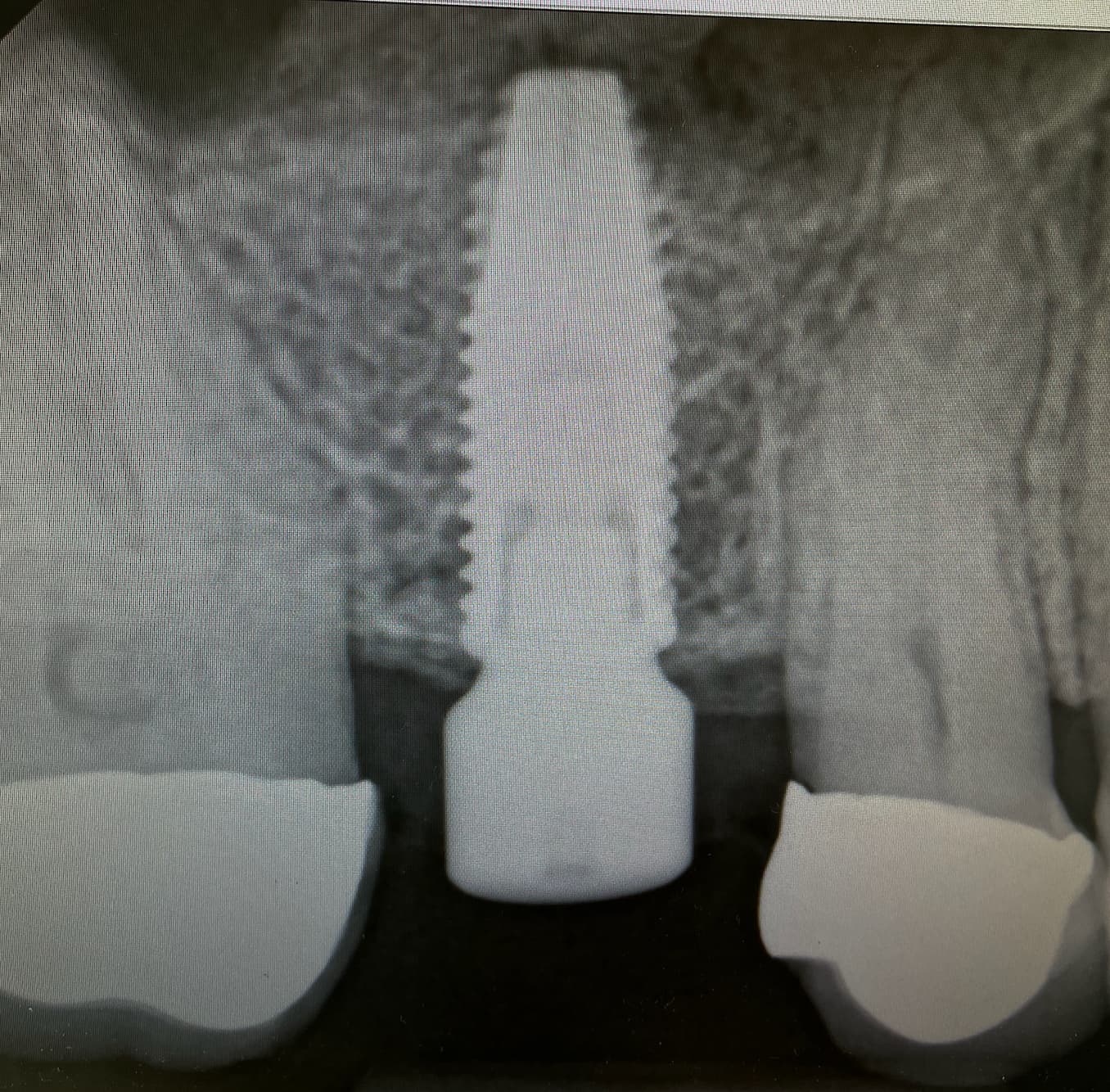 Chirurgie d'implants dentaires Image 2