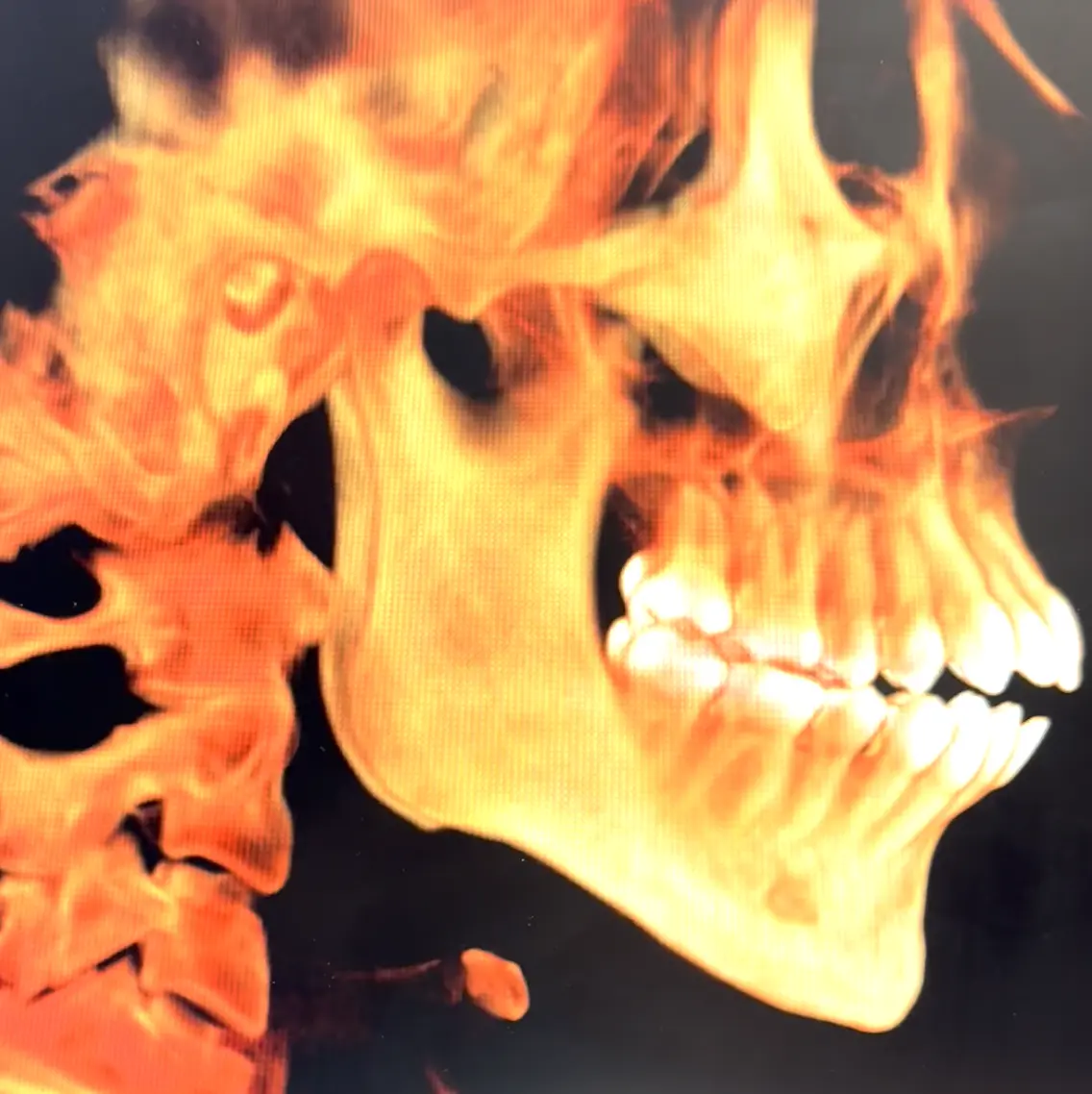 Orthognathic Surgery Image 1