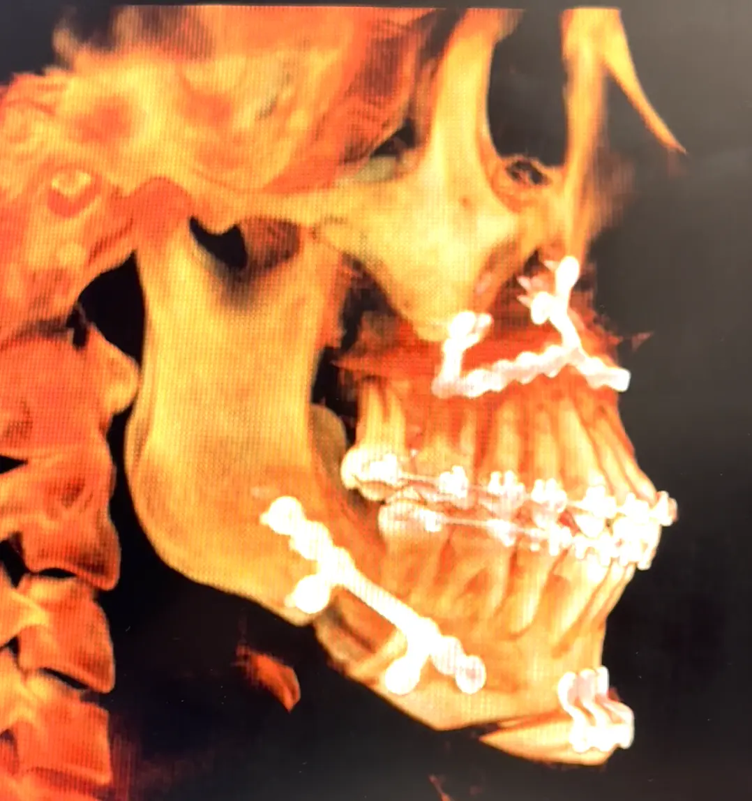 Orthognathic Surgery Image 2