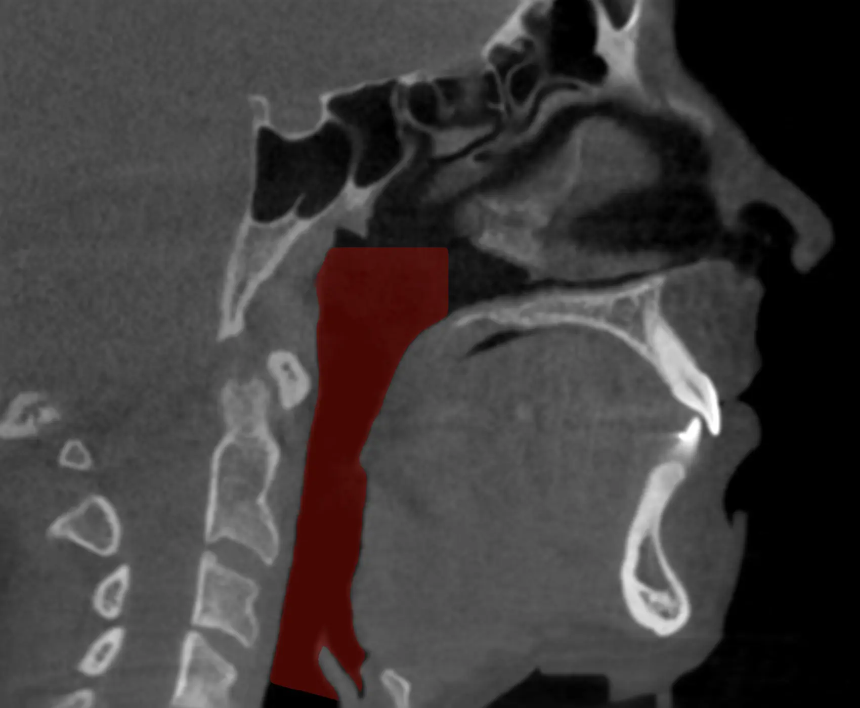 Apnée du sommeil Image 2