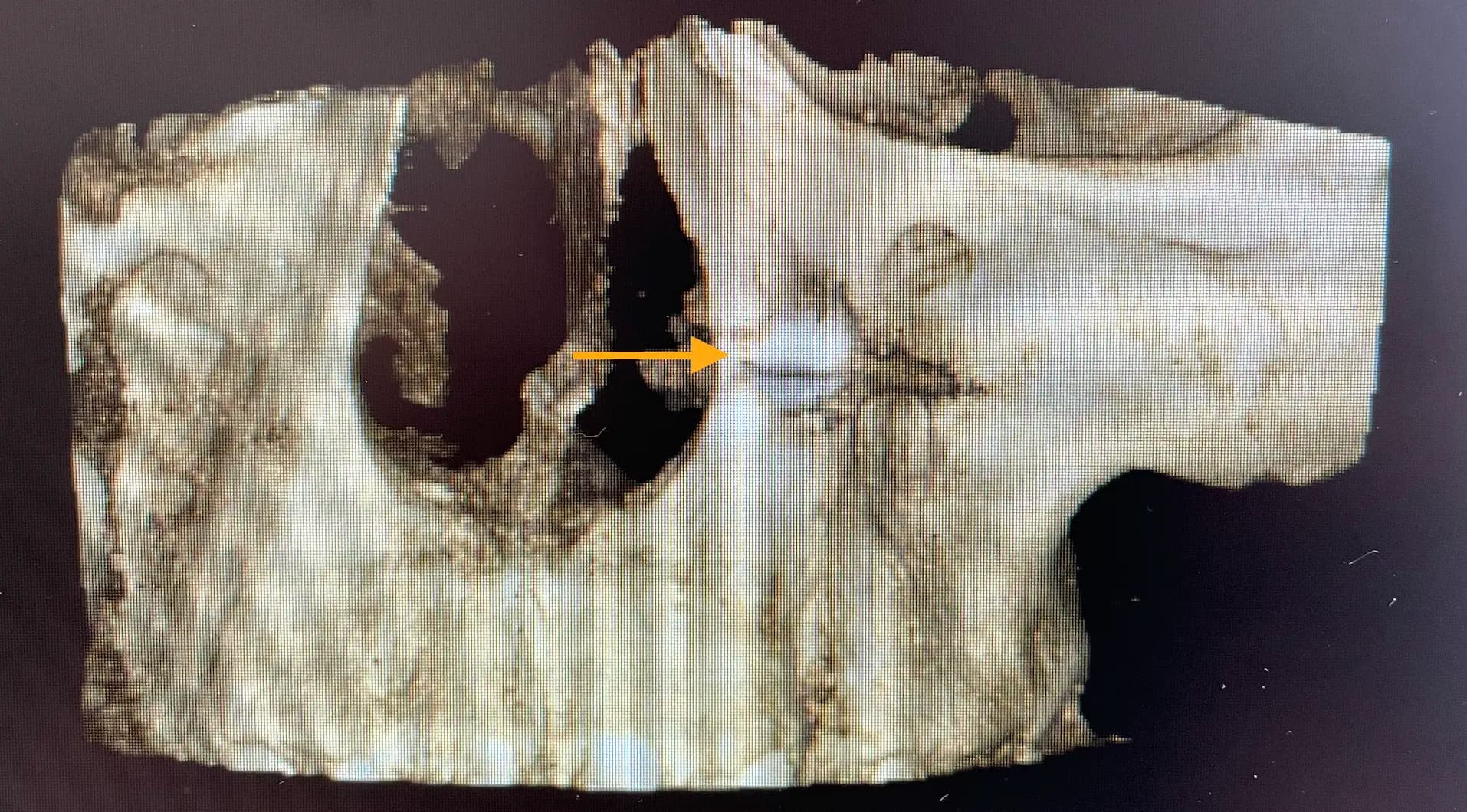 Image d’aperçu d’exposition chirurgicale des dents