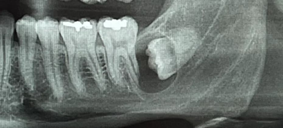 Wisdom Teeth Extraction Image 2