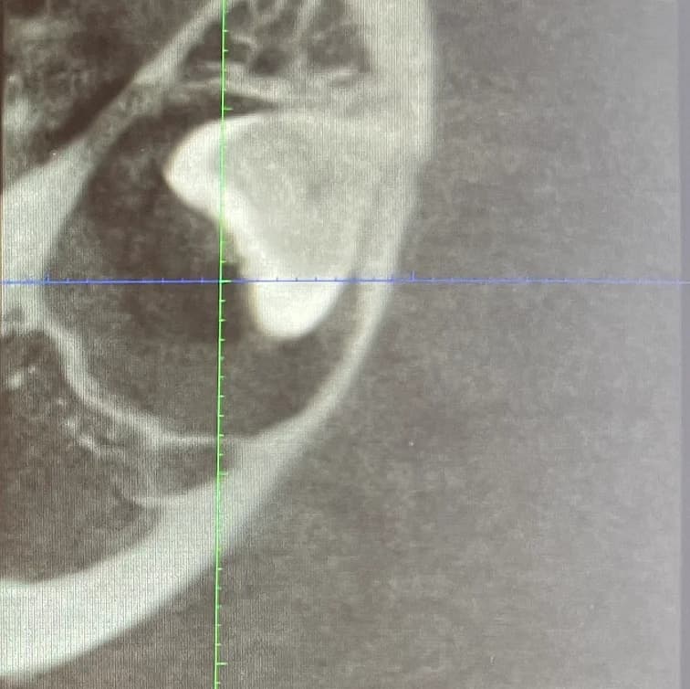 Wisdom Teeth Extraction Image 3