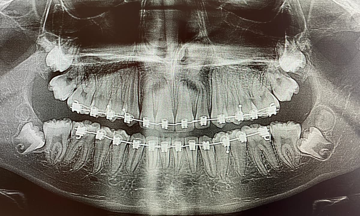 Wisdom Teeth Extraction Overview Image